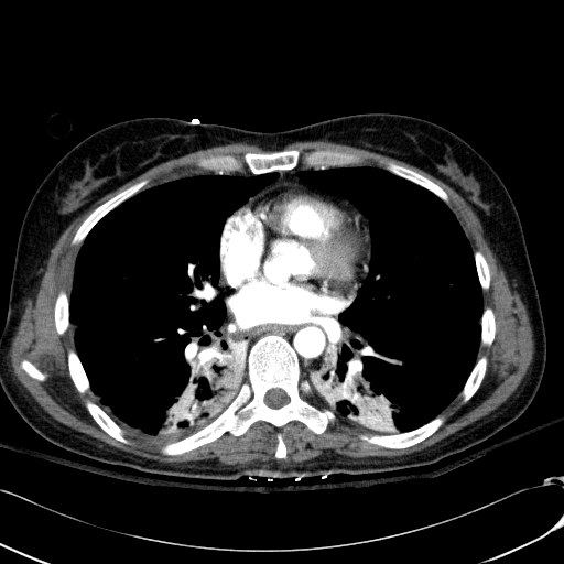 File:Acute myocardial infarction in CT (Radiopaedia 39947-42415 Axial C+ arterial phase 79).jpg