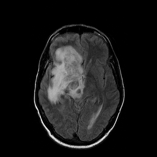 File:Acute necrotizing toxoplasma encephalitis (Radiopaedia 10683-11149 Axial FLAIR 10).jpg