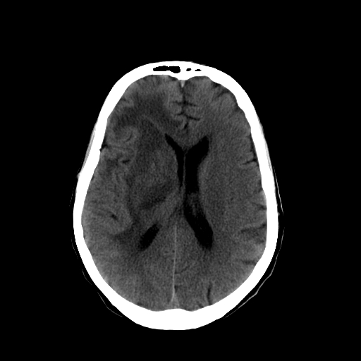 File:Acute necrotizing toxoplasma encephalitis (Radiopaedia 10683-11150 B 14).jpg