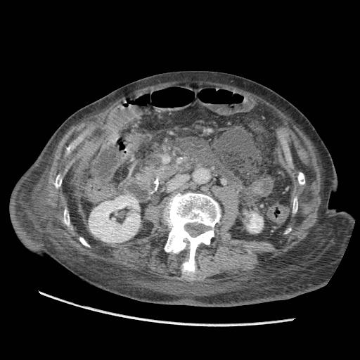 Acute on chronic pancreatitis (Radiopaedia 13233-13244 Axial C+ portal venous phase 53).jpg