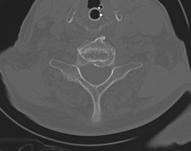 Acute on chronic subdural hematoma and thoracic vertebral injury in a multitrauma patient (Radiopaedia 31698-32619 Axial bone window 43).jpg