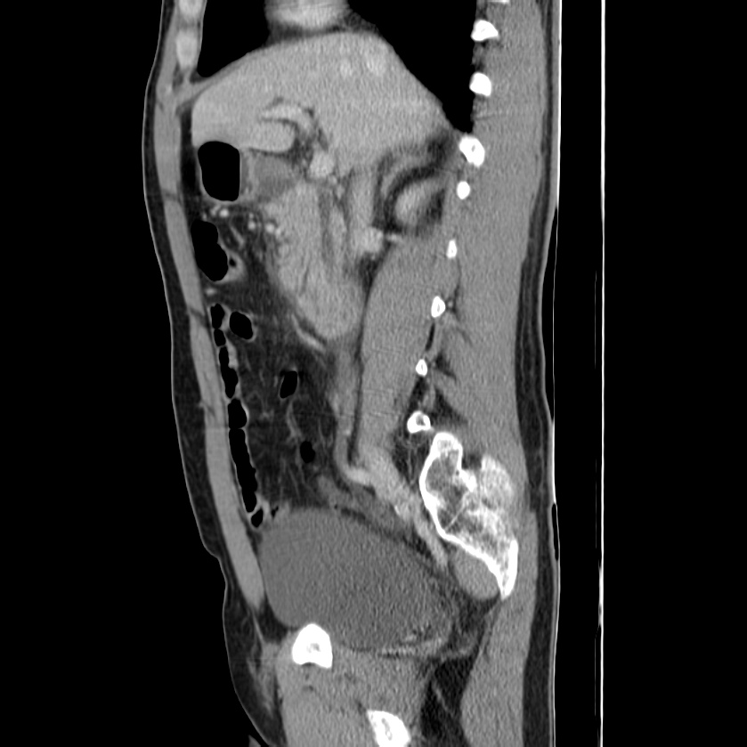 Acute pancreatitis (Radiopaedia 22572-22596 Sagittal C+ portal venous phase 22).jpg