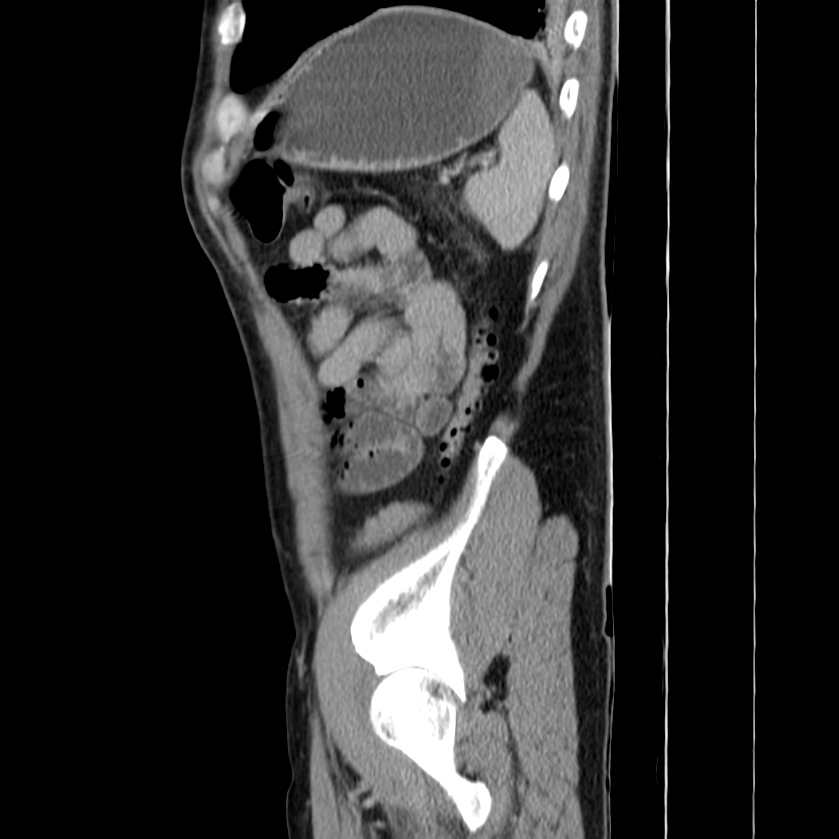 Acute pancreatitis (Radiopaedia 22572-22596 Sagittal C+ portal venous phase 45).jpg