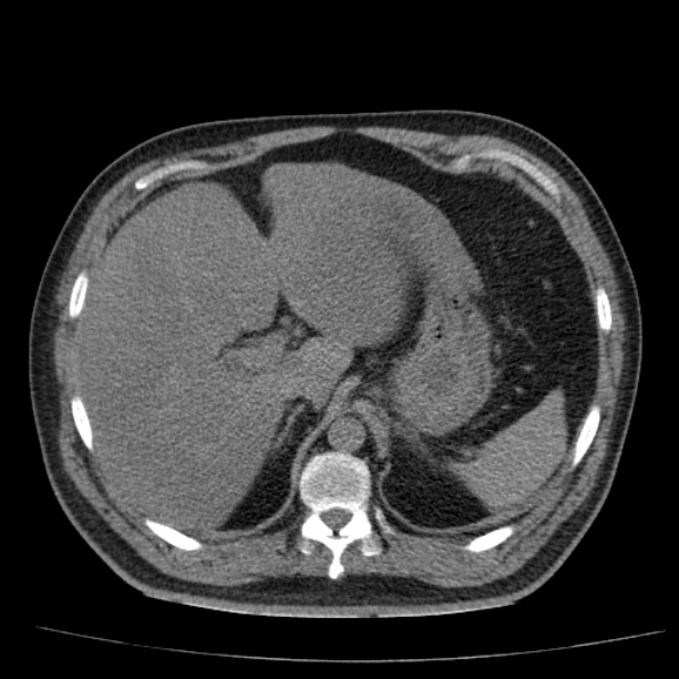 Acute pancreatitis (Radiopaedia 26663-26813 Axial non-contrast 25).jpg