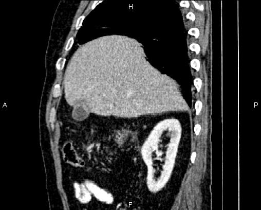 Acute pancreatitis (Radiopaedia 85146-100701 Sagittal C+ portal venous phase 21).jpg