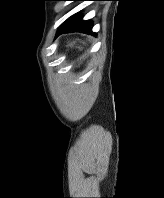 Acute pancreatitis - Balthazar E (Radiopaedia 23080-23110 Sagittal C+ portal venous phase 97).jpg
