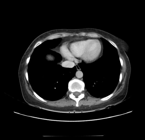 File:Acute pancreatitis - Balthazar E - post ERCP (Radiopaedia 27562-27772 Axial C+ portal venous phase 6).png