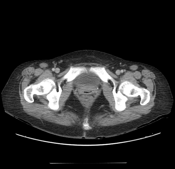 Acute pancreatitis - Balthazar E - post ERCP (Radiopaedia 27562-27772 Axial C+ portal venous phase 76).png