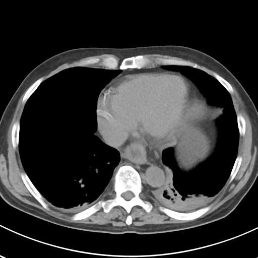 File:Acute pancreatitis and walled-off necrosis (Radiopaedia 29888-30404 Axial non-contrast 3).jpg
