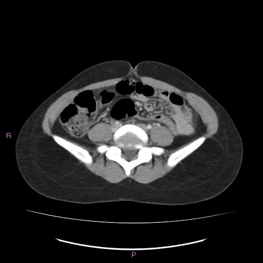 Acute pancreatitis secondary to stone at minor papilla and pancreatic divisum (Radiopaedia 76570-88333 Axial C+ portal venous phase 50).jpg