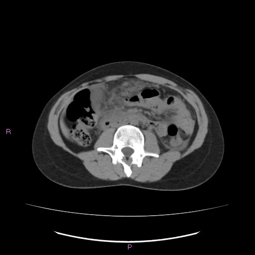 Acute pancreatitis secondary to stone at minor papilla and pancreatic divisum (Radiopaedia 76570-88333 Axial non-contrast 37).jpg