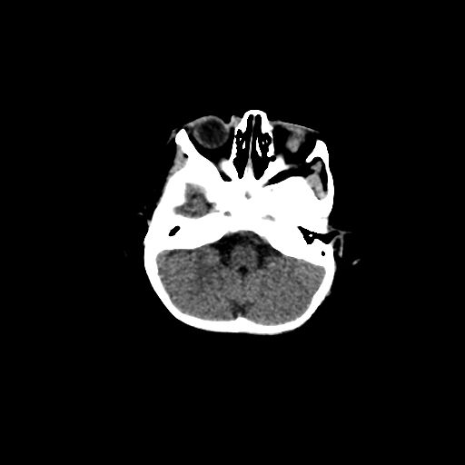 Acute phase of hemiconvulsion-hemiplegia epilepsy syndrome (Radiopaedia 29309-29744 Axial non-contrast 43).jpg