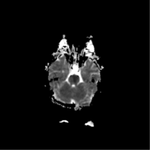 File:Acute pontine infarct from vertebral artery dissection (Radiopaedia 34111-35370 Axial ADC 7).png