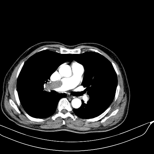 File:Acute pulmonary embolism (Radiopaedia 69510-79390 D 10).jpg