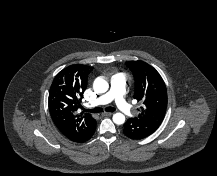 Acute pulmonary embolism with pulmonary infarcts (Radiopaedia 77688-89908 Axial C+ CTPA 24).jpg