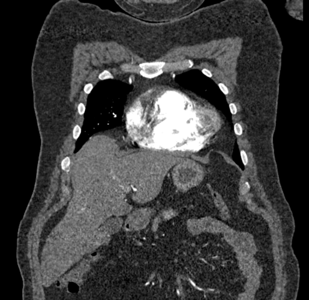 Acute pulmonary embolism with pulmonary infarcts (Radiopaedia 77688-89908 Coronal C+ CTPA 7).jpg
