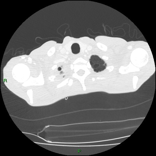 File:Acute right lung abscess (Radiopaedia 34806-36258 Axial lung window 8).jpg