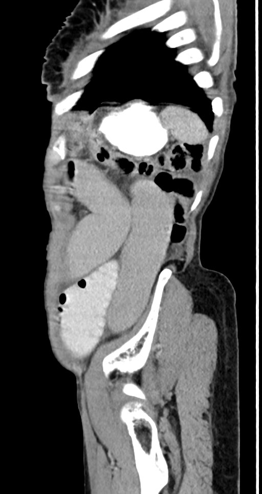 Acute small bowel (ileal) volvulus (Radiopaedia 71740-82139 Sagittal C+ portal venous phase 37).jpg