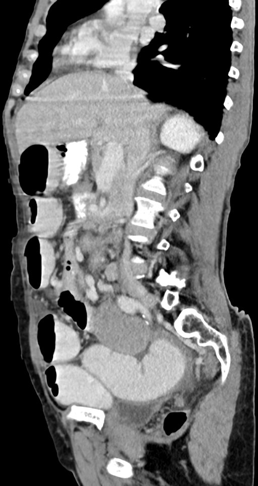 Acute small bowel (ileal) volvulus (Radiopaedia 71740-82139 Sagittal C+ portal venous phase 99).jpg