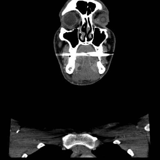 File:Acute submandibular sialadenitis secondary to ductal stone (Radiopaedia 27999-28267 D 14).jpg