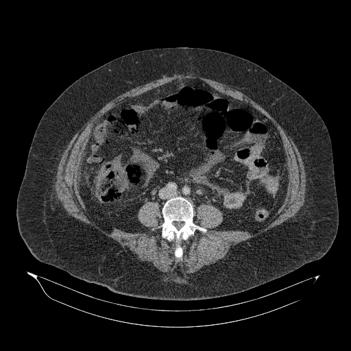 File:Acute superior mesenteric artery occlusion (Radiopaedia 51288-56960 Axial C+ portal venous phase 60).jpg
