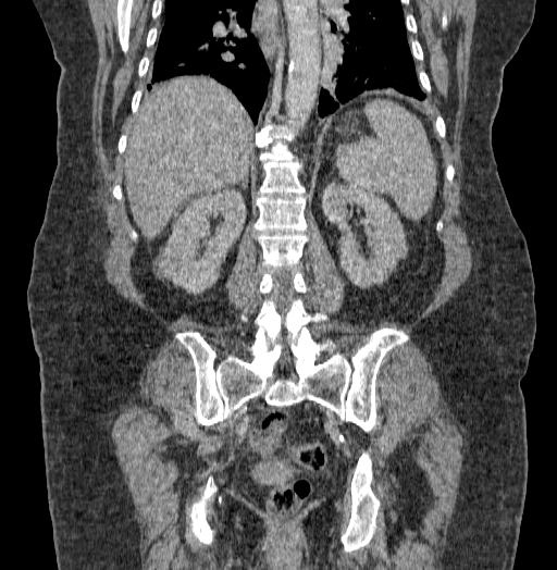 Acute superior mesenteric artery occlusion (Radiopaedia 51288-56960 Coronal C+ portal venous phase 54).jpg