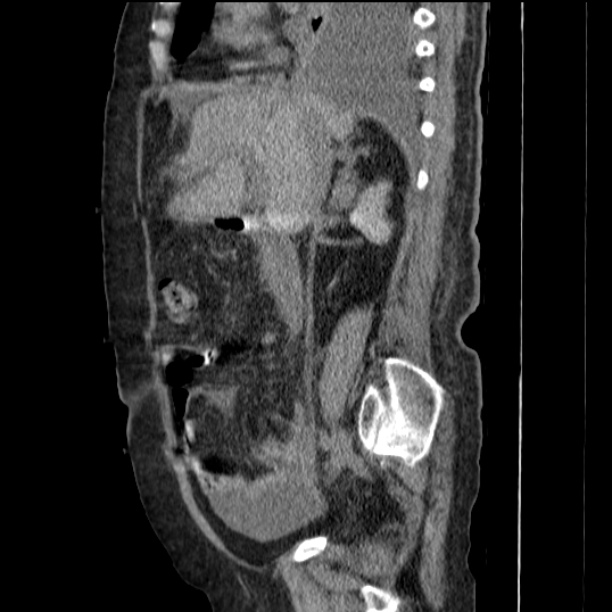 Acute tubular necrosis (Radiopaedia 28077-28334 H 36).jpg