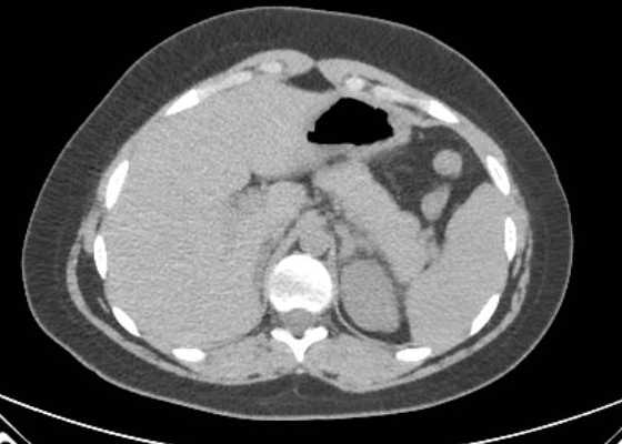 Acute unilateral nonhemorrhagic adrenal infarction (Radiopaedia 67560-76957 Axial non-contrast 24).jpg