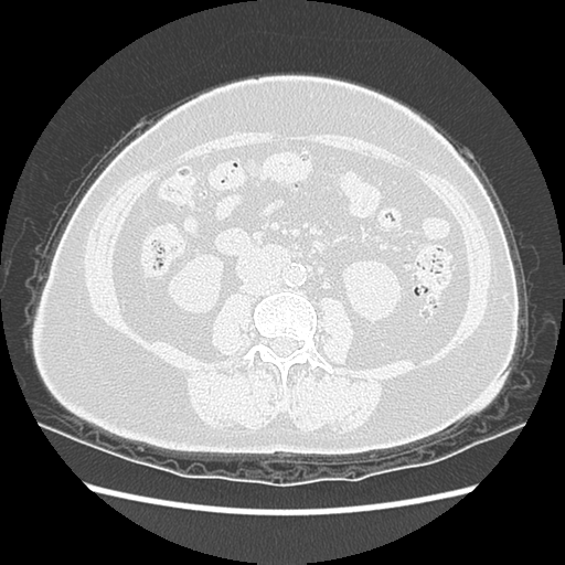 Adenocarcinoma in situ of lung (Radiopaedia 38685-40829 B 288).png