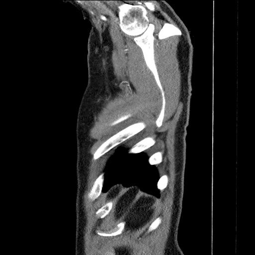 Adenocarcinoma of the lung (Radiopaedia 59871-67325 Sagittal C+ arterial phase 98).jpg