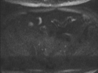 Adenocarcioma of rectum- T1 lesion (Radiopaedia 36921-38546 Axial DWI 52).png