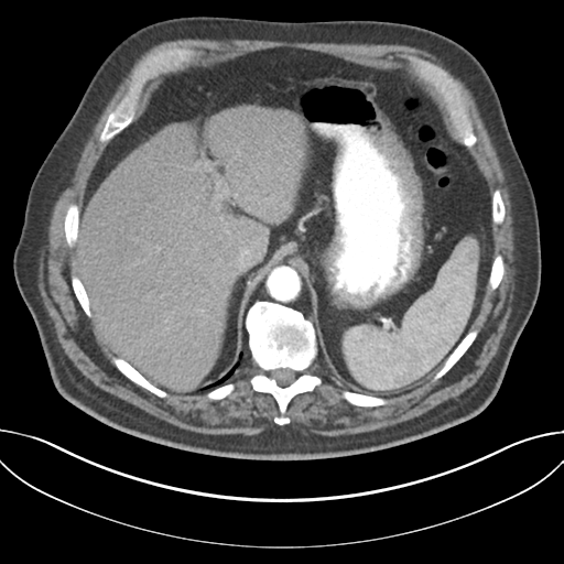 Adenocarcioma of rectum- T1 lesion (Radiopaedia 36921-38547 Axial C+ arterial phase 51).png