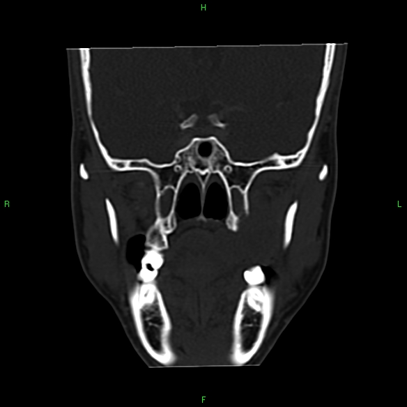 File:Adenoid cystic carcinoma of hard palate (Radiopaedia 26137-26273 Coronal bone window 15).jpg