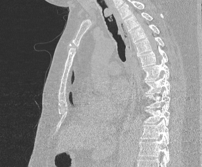Adenoid cystic carcinoma of the trachea (Radiopaedia 49042-54137 Sagittal lung window 247).jpg