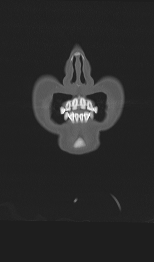 Adenoid cystic tumor of palate (Radiopaedia 46980-51518 Coronal bone window 9).png