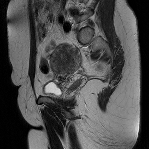 File:Adenomyosis-scar endometriosis (Radiopaedia 65863-75022 Sagittal T2 19).jpg