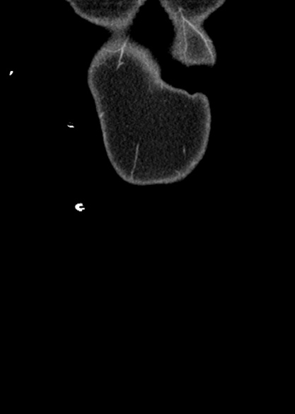 Adhesional small bowel obstruction (Radiopaedia 48397-53305 Coronal C+ portal venous phase 9).jpg