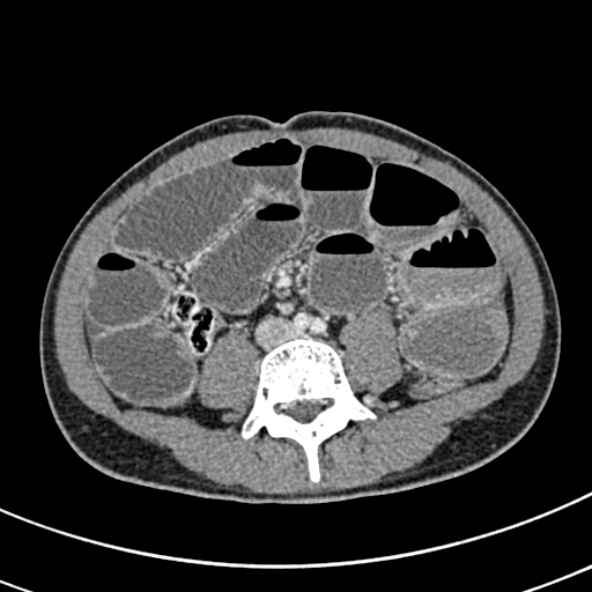File:Adhesional small bowel obstruction (Radiopaedia 52107-57980 Axial C+ portal venous phase 74).jpg