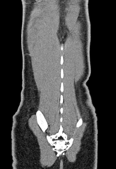 Adhesional small bowel obstruction (Radiopaedia 52107-57980 Coronal C+ portal venous phase 76).jpg