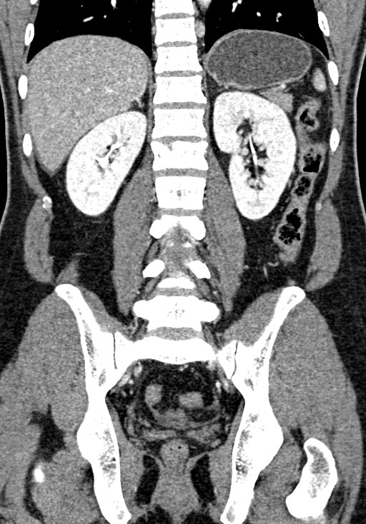 Adhesional small bowel obstruction (Radiopaedia 58900-66131 Coronal C+ portal venous phase 177).jpg
