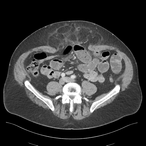 Adhesions within abdominal wall hernia (Radiopaedia 58283-65394 Axial C+ portal venous phase 54).png