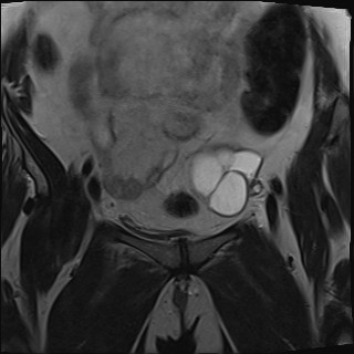 File:Adnexal multilocular cyst (O-RADS US 3- O-RADS MRI 3) (Radiopaedia 87426-103754 Coronal T2 9).jpg