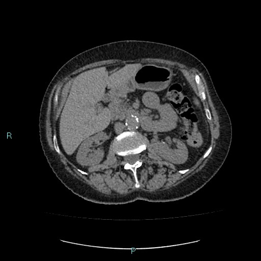 File:Adrenal collision tumor (ACT) (Radiopaedia 48462-53379 Axial non-contrast 22).jpg