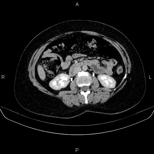 Adrenal cortical carcinoma (Radiopaedia 84882-100379 Axial C+ delayed 42).jpg