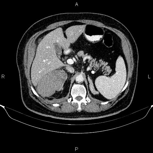 Adrenal hemorrhage (Radiopaedia 62622-70916 Axial C+ portal venous phase 54).jpg