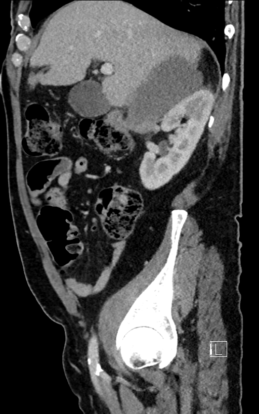 Adrenal lymphoma (Radiopaedia 73730-84529 Sagittal C+ portal venous phase 35).jpg