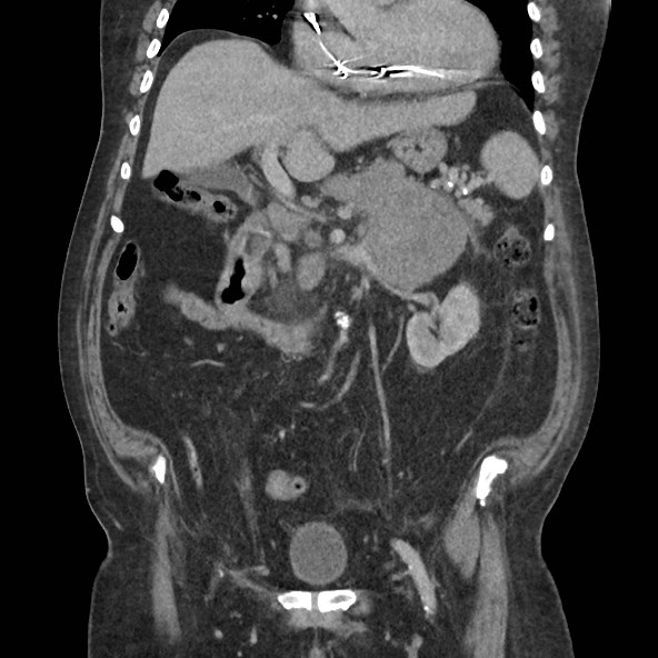 Adrenal lymphoma (Radiopaedia 84145-99415 Coronal C+ portal venous phase 37).jpg