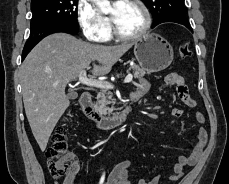 Adrenal metastases (Radiopaedia 73082-83791 Coronal C+ arterial phase 6).jpg
