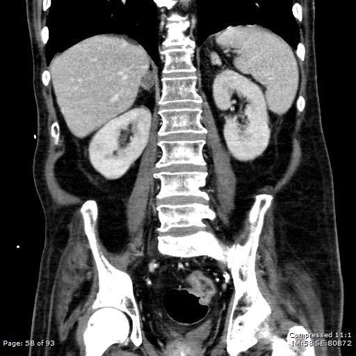 Adrenal metastasis (Radiopaedia 78425-91079 Sagittal C+ portal venous phase 45).jpg