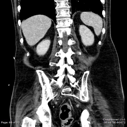 Adrenal metastasis (Radiopaedia 78425-91079 Sagittal C+ portal venous phase 53).jpg